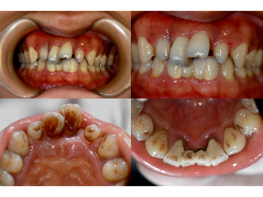 牙周基础治疗的临床病例介绍课件_第1页