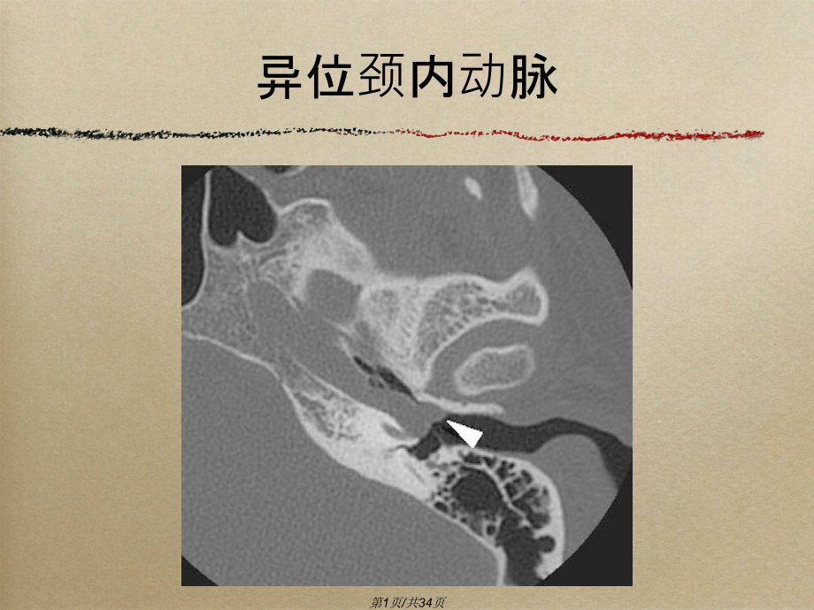 搏动性耳鸣影像表现课件_第1页