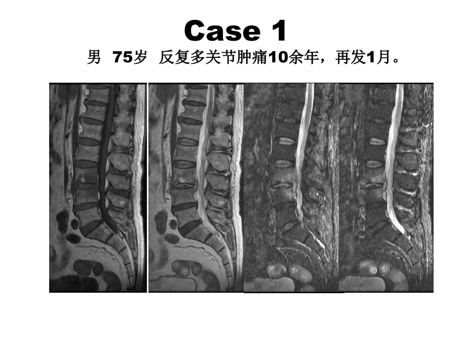 医学ppt课件脊柱结核的影像诊断_第1页