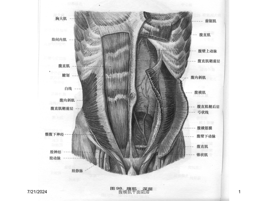 腹横肌平面阻滞培训课件_第1页