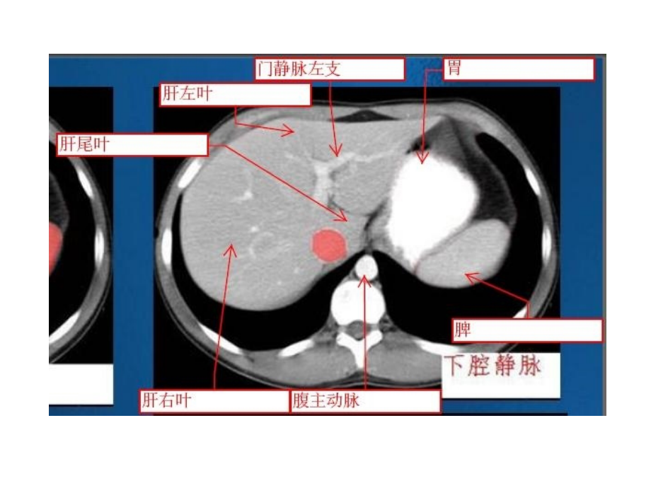 腹部ct精美示意图教学课件_第1页