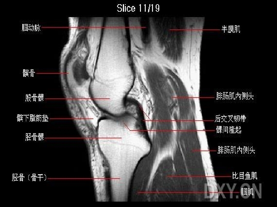 膝关节核磁振教学课件_第1页