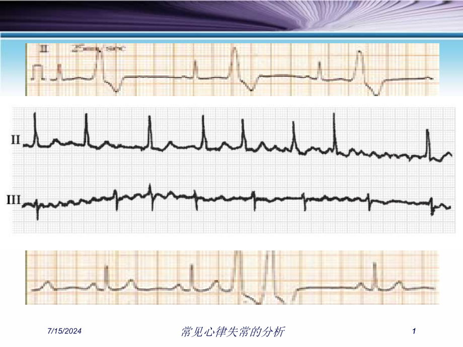 常见心律失常的分析ppt课件_第1页