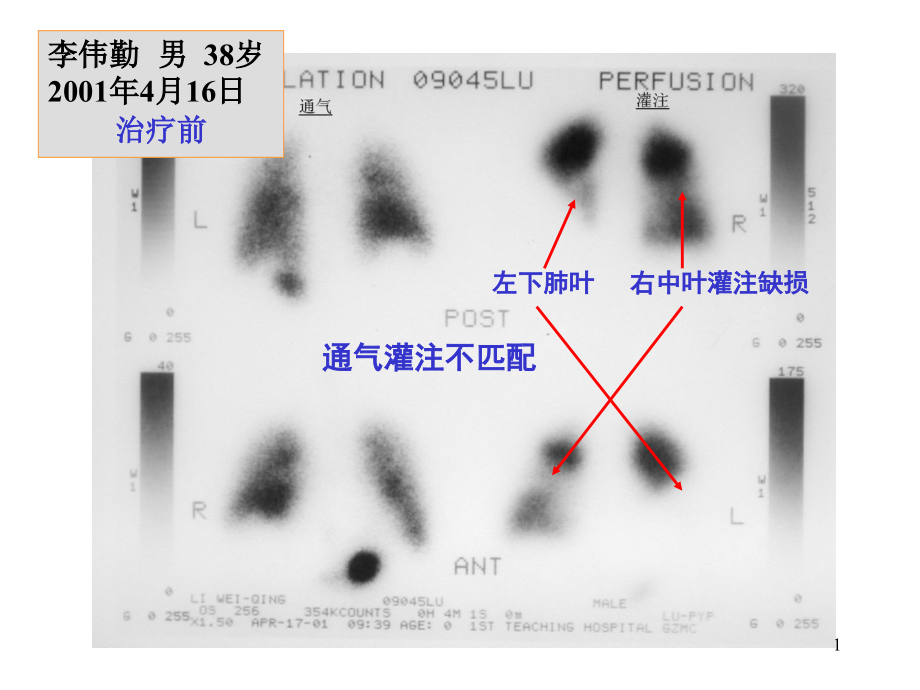 急性肺栓塞图片-课件_第1页