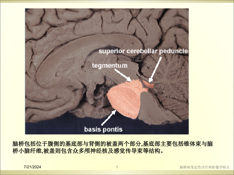 脑桥病变定性诊疗和影像学特点培训课件_第1页