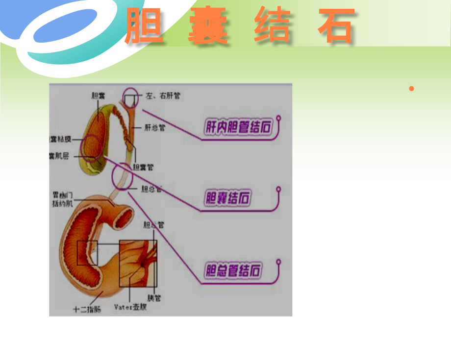 胆囊结石护理课件_第1页