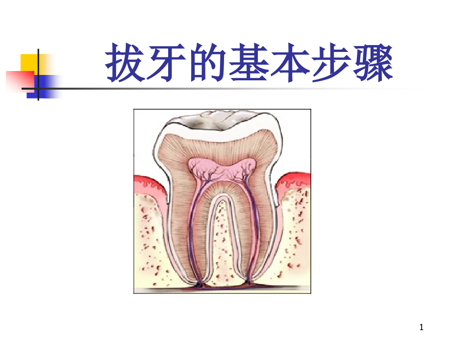 一般牙拔除术课件_第1页