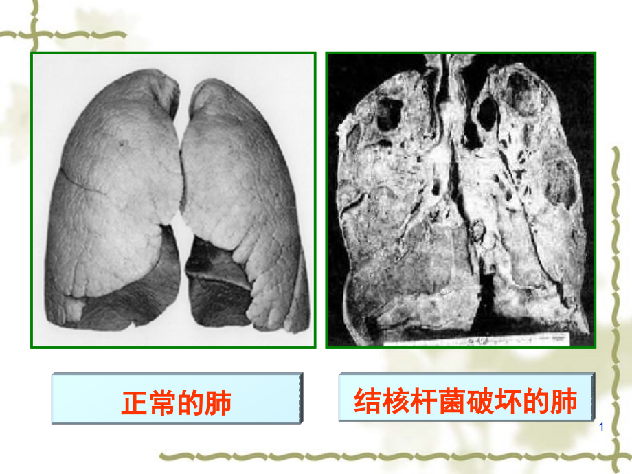 结核病防治知识ppt课件_第1页