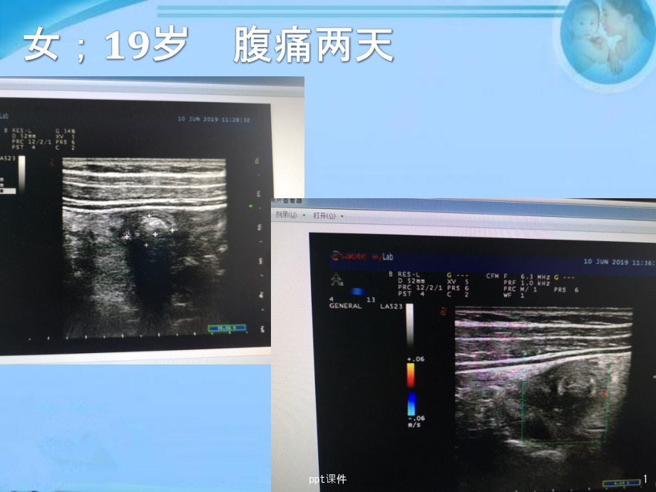 结肠憩室的超声诊断--课件_第1页