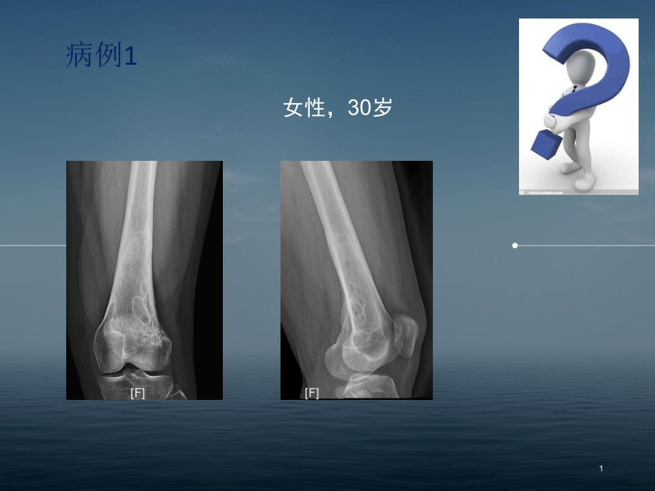 非骨化性纤维瘤的x线诊断及鉴别诊断-课件_第1页