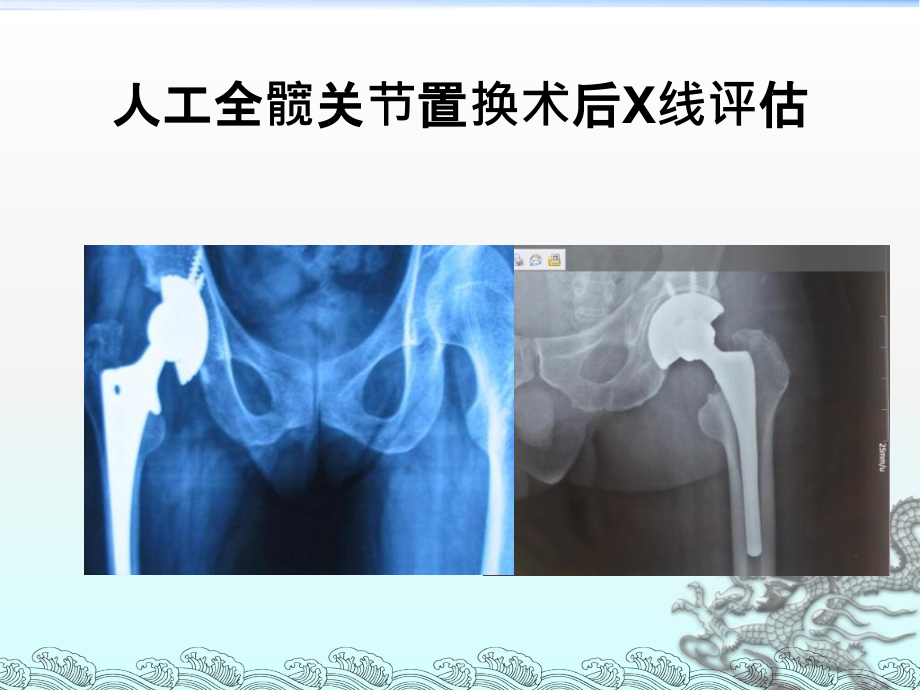 髋关节置换术后X线评估课件_第1页