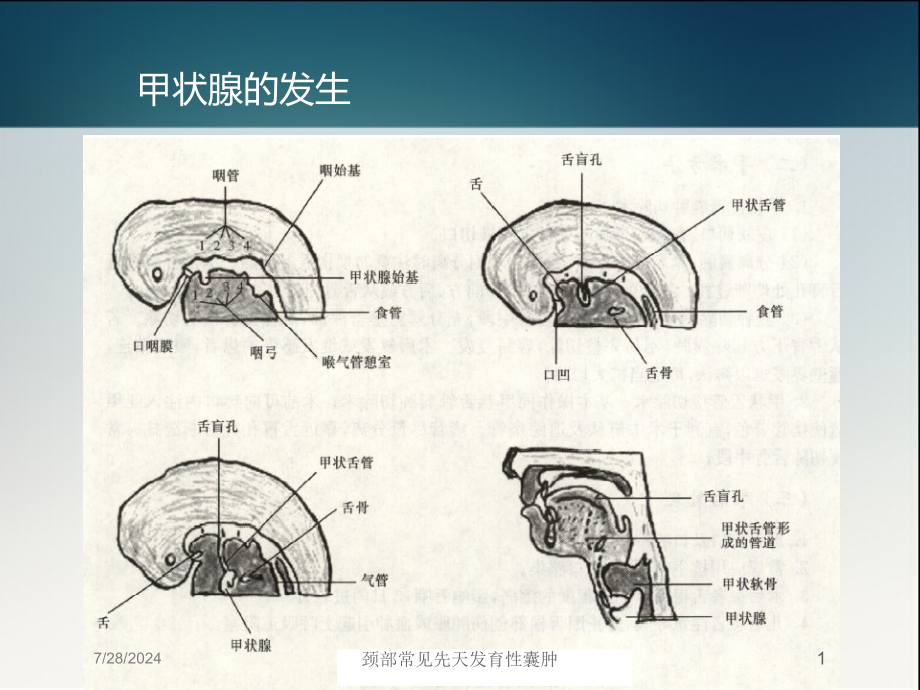 颈部常见先天发育性囊肿培训课件_第1页