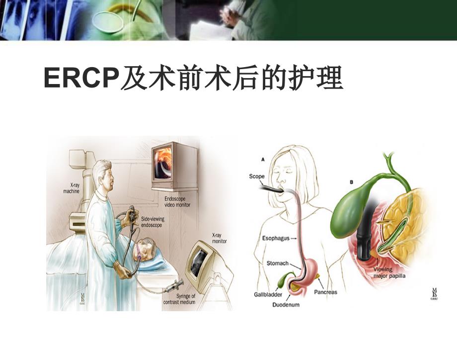 医学课件-ERCP及术前术后护理教学课件_第1页