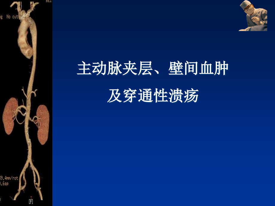 主动脉夹层、壁内血肿及穿透溃疡课件_第1页