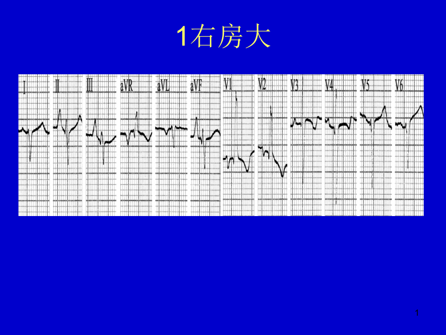 心电图典型图谱课件_第1页