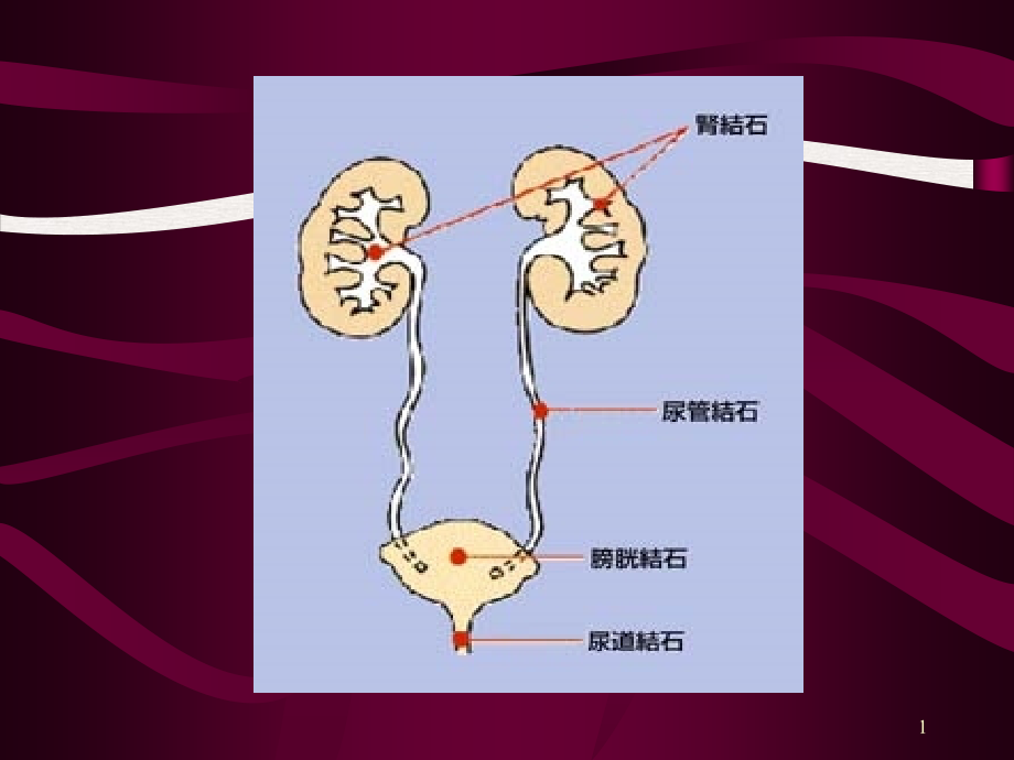 泌尿结石病人的护理实用版课件_第1页