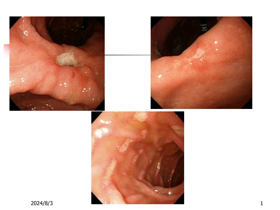 消化性溃疡新-课件_第1页