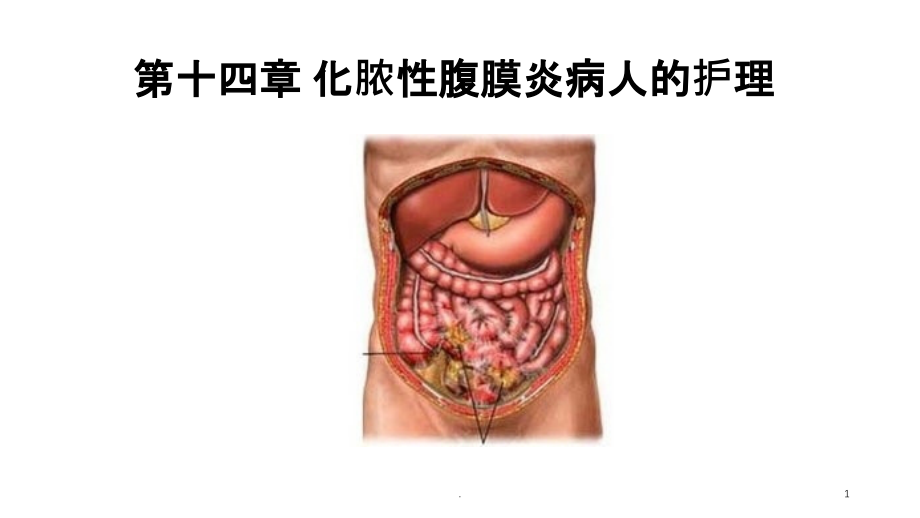 急性化脓性腹膜炎病人的护理课件整理_第1页