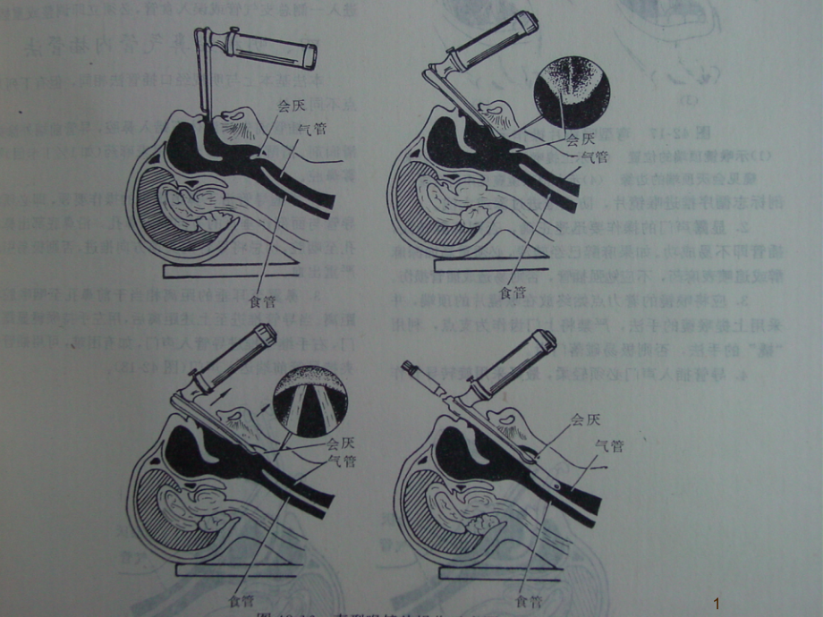 气管内插管术及深静脉置管课件_第1页