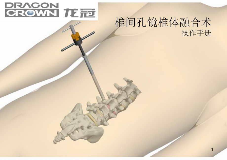 椎间孔镜可膨胀式椎间融合器操作手册课件_第1页