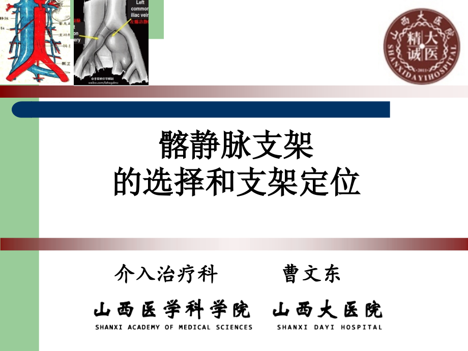 髂静脉支架的选择和支架定位课件_第1页