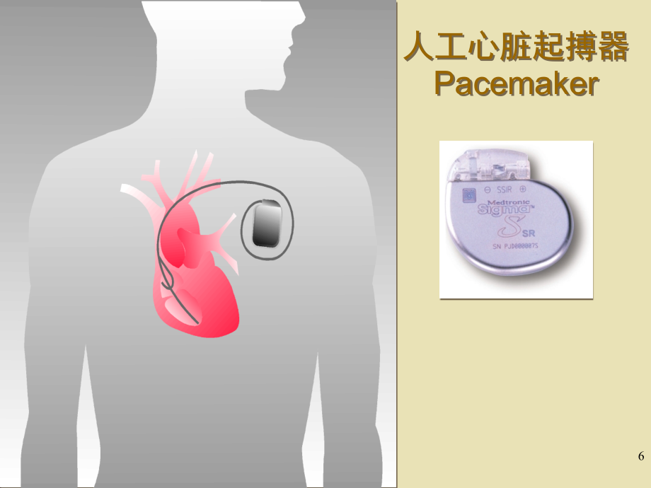 永久性心脏起搏器临床应用课件_第1页