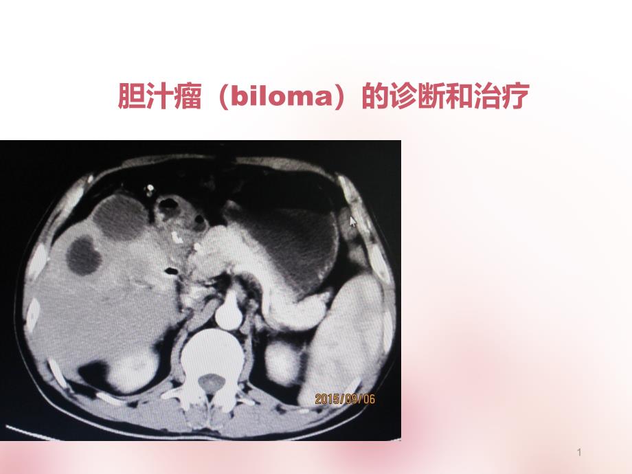 胆汁瘤(biloma)的诊断和治疗--课件_第1页