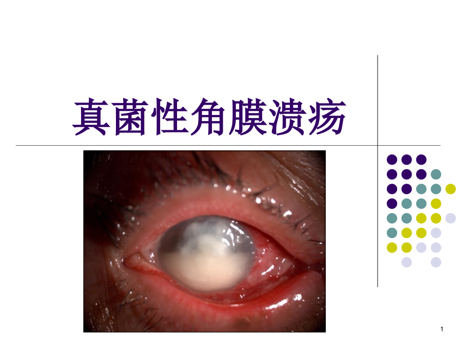 真菌性角膜溃疡课件_第1页