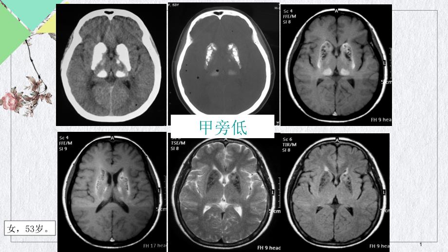 甲状旁腺功能减退症课件_第1页