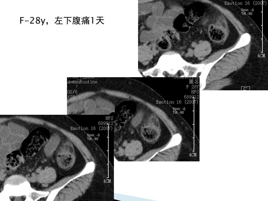 腹腔炎性脂肪性肿块的鉴别诊断课件_第1页