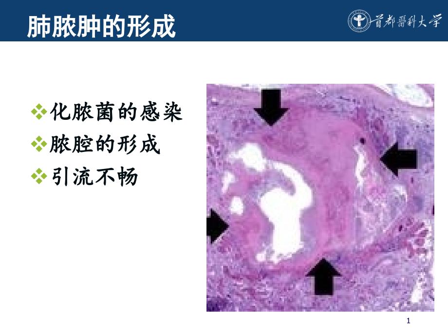 肺脓肿抗菌治疗课件_第1页