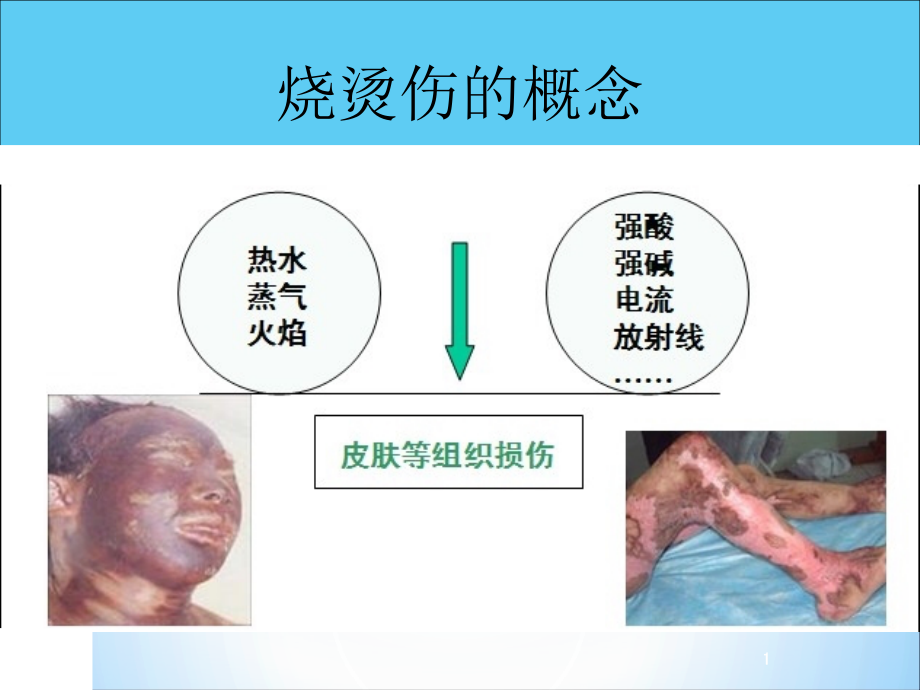 烧烫伤急救处理-课件_第1页