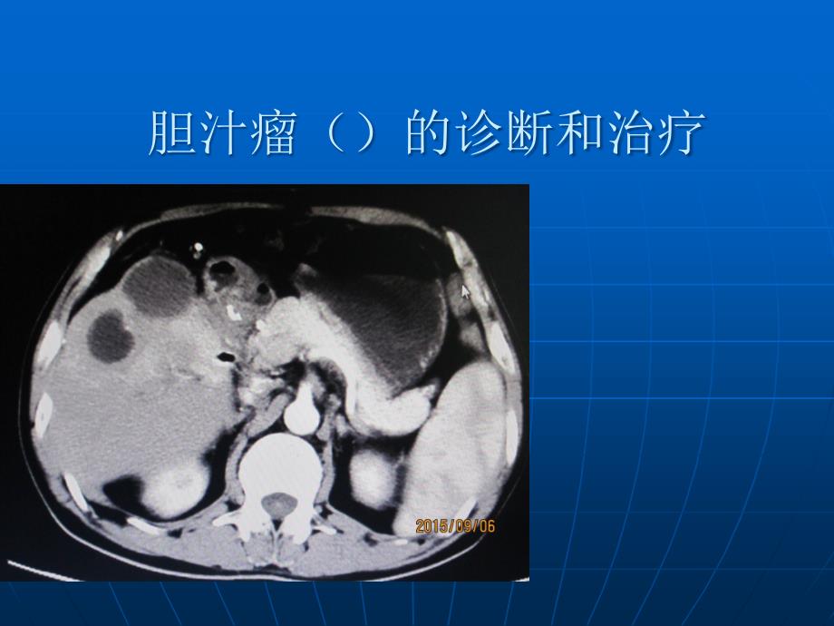 胆汁瘤(biloma)的诊断和治疗课件_第1页