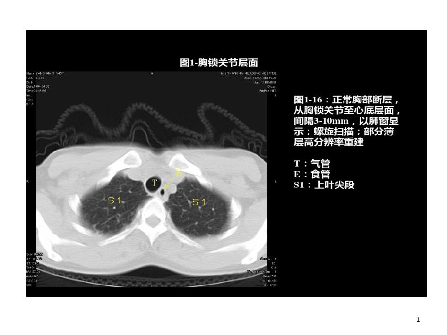 胸部CT影像学表现课件_第1页