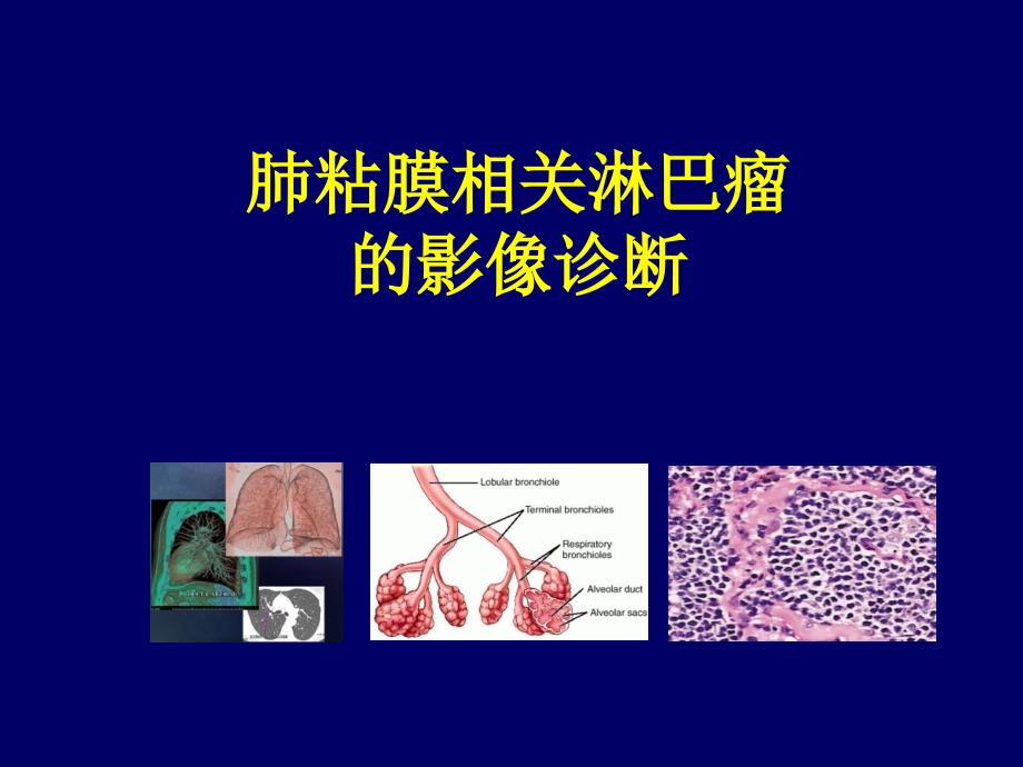 肺粘膜相关淋巴瘤的影像学诊断课件_第1页