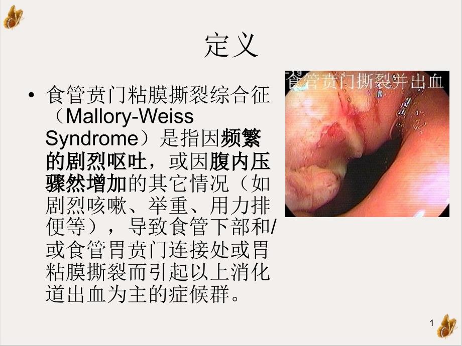 食管贲门粘膜撕裂综合征-课件_第1页