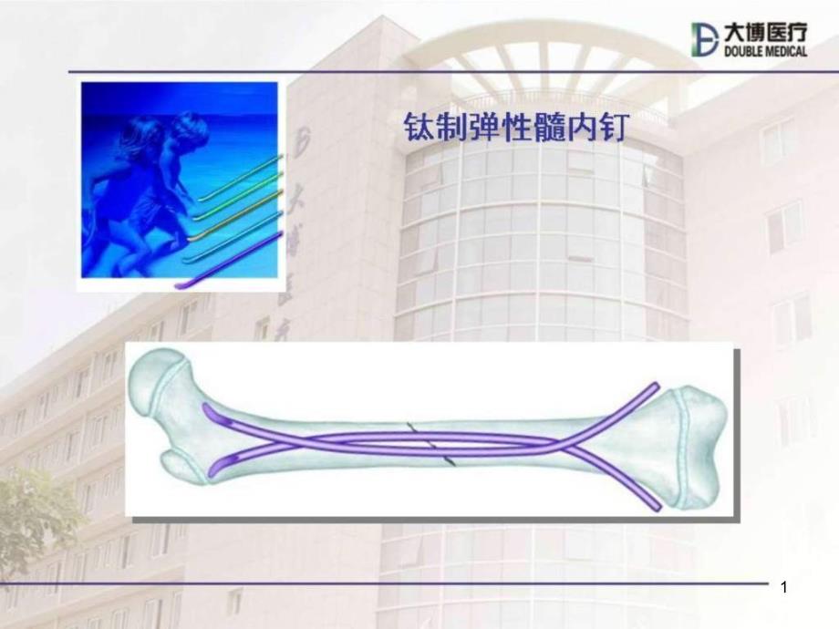 弹性髓内钉治疗儿童骨折操作技巧课件_第1页