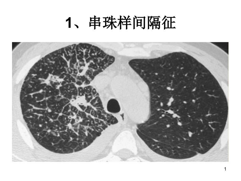 胸部医学影像征象总结课件_第1页