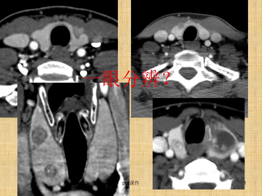甲状腺乳头状癌CT征象--课件_第1页
