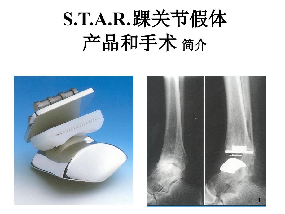 踝关节置换手术步骤PPT幻灯片课件_第1页