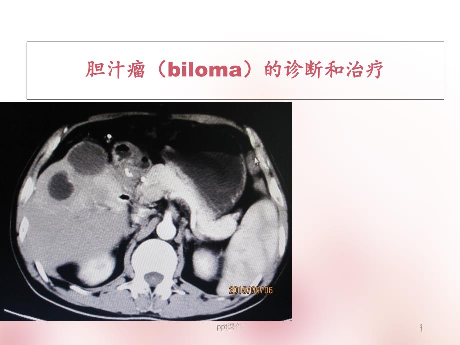 胆汁瘤(biloma)的诊断和治疗--课件_第1页