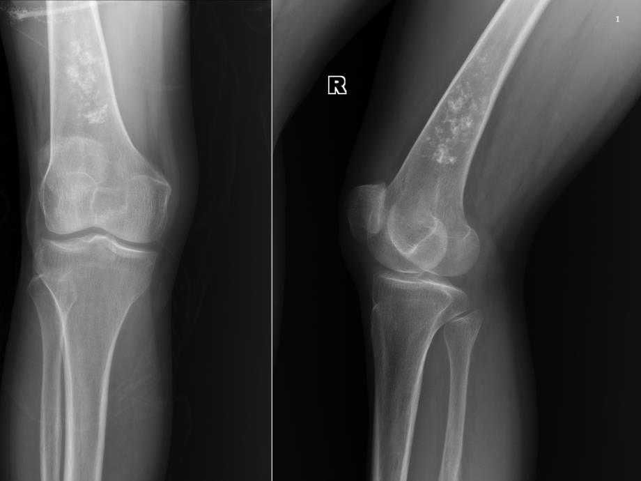 骨梗死影像诊断读片-1-课件_第1页