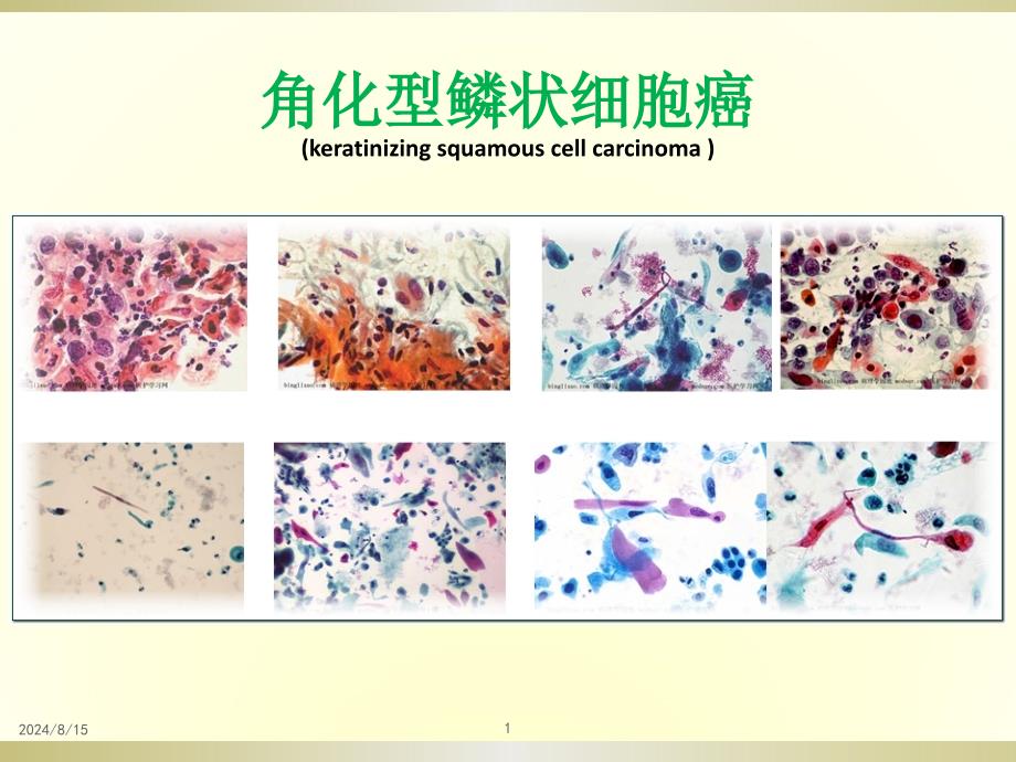 鳞状细胞癌参考ppt课件_第1页