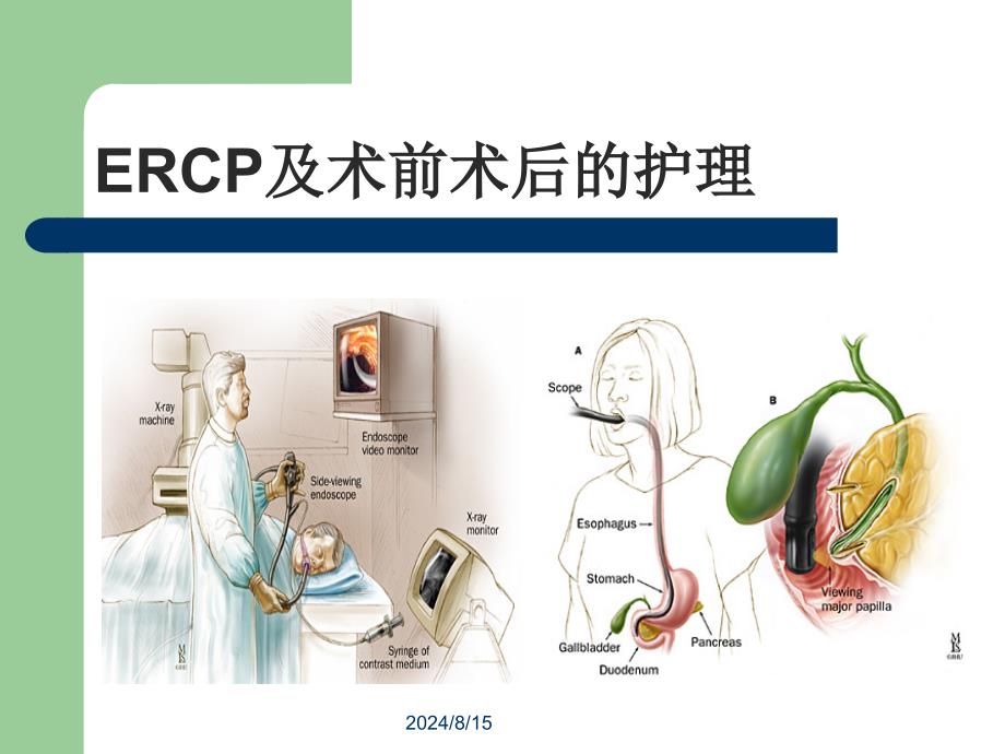 ERCP及术前术后护理课件_第1页