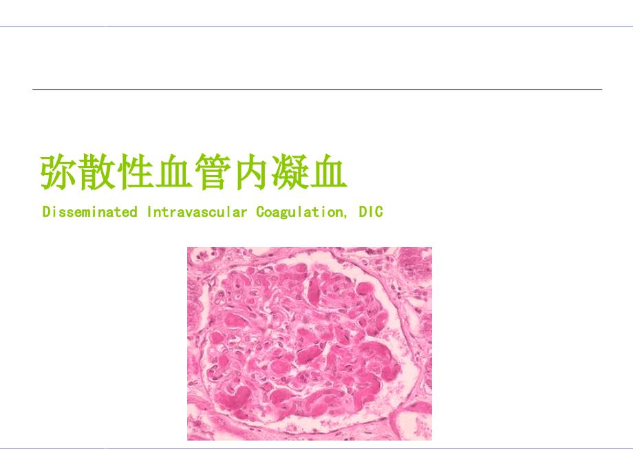 DIC的诊断及治疗课件_第1页