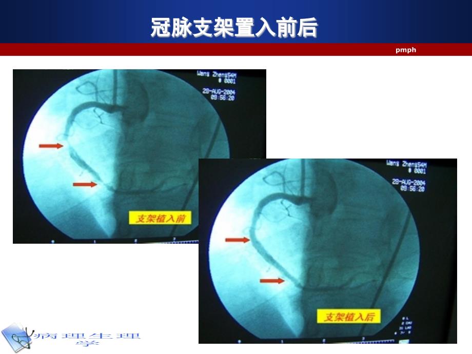 医学超级全之病生（临7）ppt课件缺血再灌注损伤_第1页