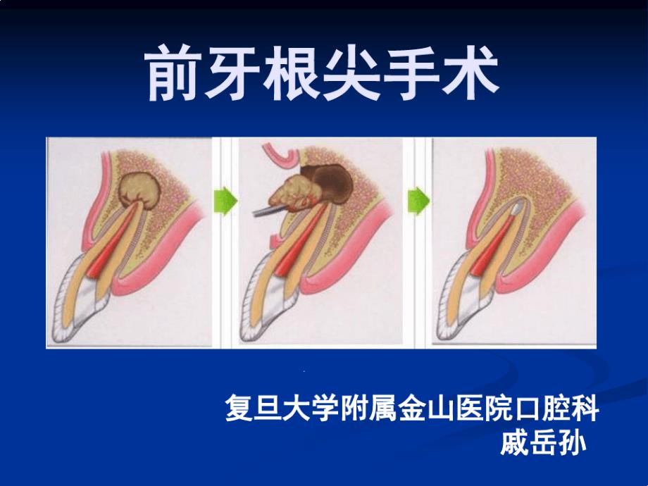 前牙根尖手术课件_第1页