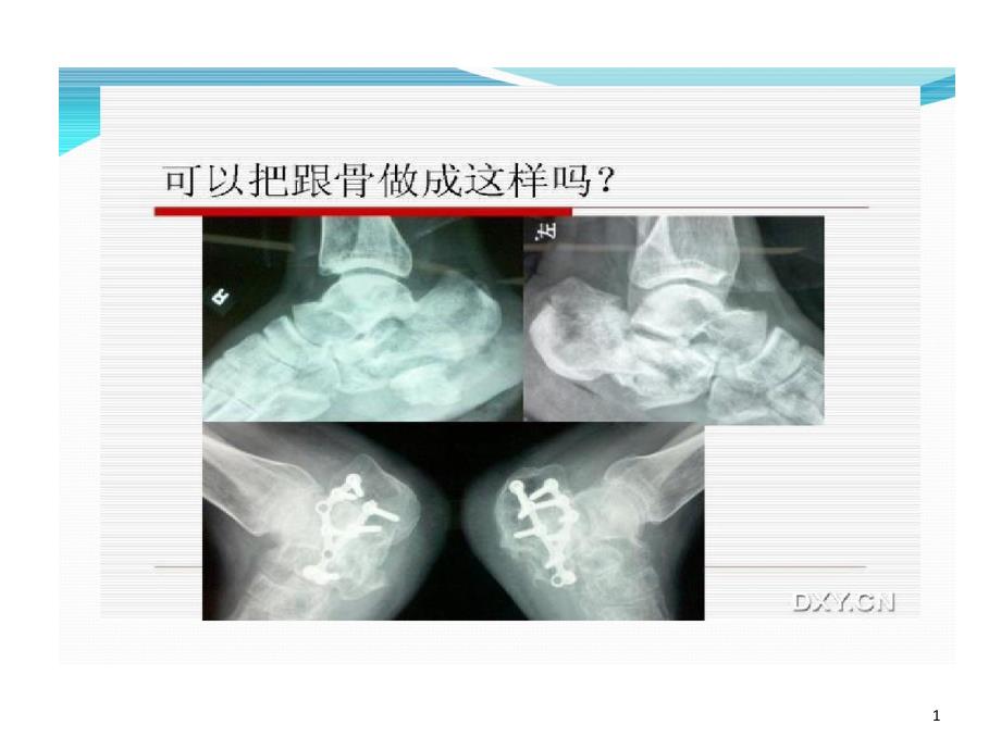 跟骨骨折治疗手术技巧课件_第1页