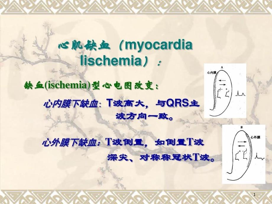 心肌缺血心电图课件_第1页