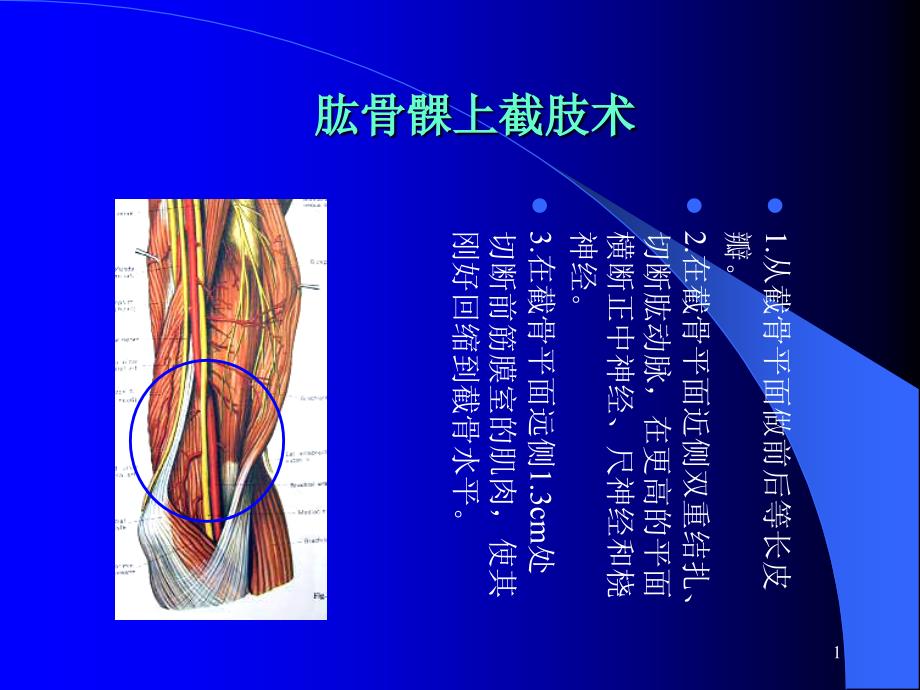 肱骨髁上截肢术课件_第1页